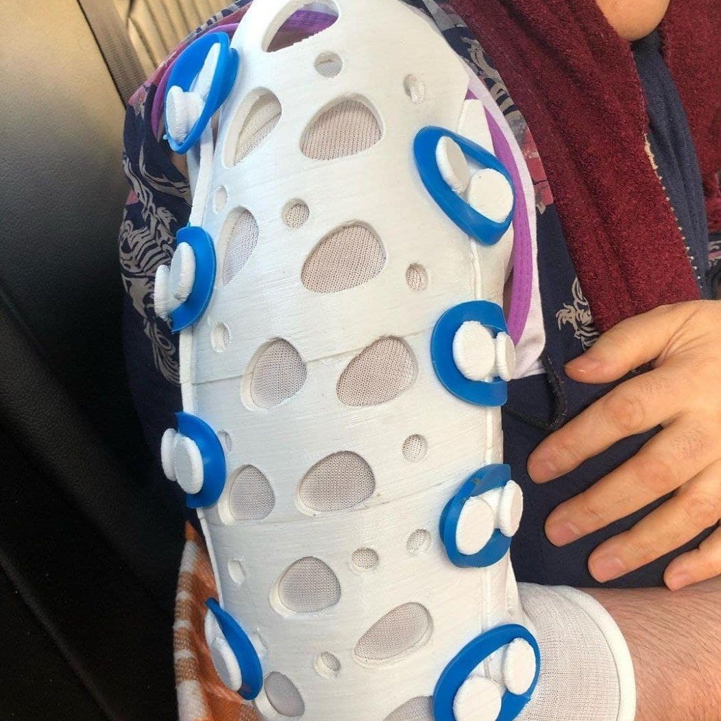 کاربرد پرینتر سه بعدی در گچ گیری شکستگی استخوان