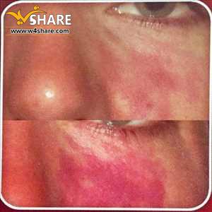 رفع قرمزی پوست صورت